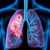 Facts About Lung Cancer